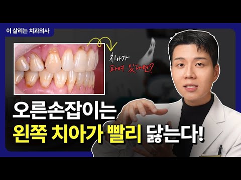 치과 질환 정보 영상 사례 - 치아 파임 원인 설명 유튜브