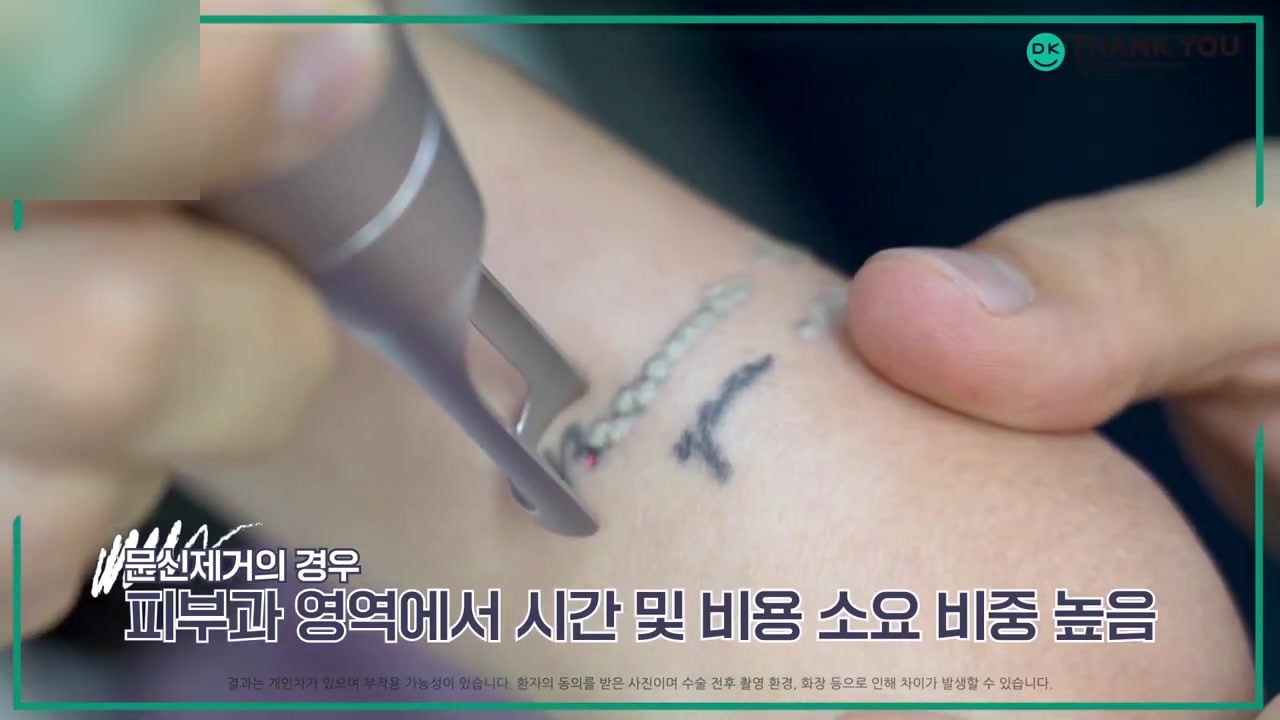 문신 제거 정보 영상 사례 - 팔의 레터링 문신에 레이저 핸드피스를 대는 시술 클로즈업과 '피부과 영역에서 시간 및 비용 소요 비중 높음' 자막이 놓인 병원 유튜브 장면